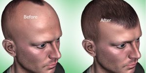 Recovery Process After Fue Hair Transplant Timeline